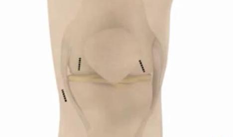 Knee joint prepared with marked insertion points